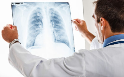 Síntomas, tratamientos y causas del cáncer de pulmón